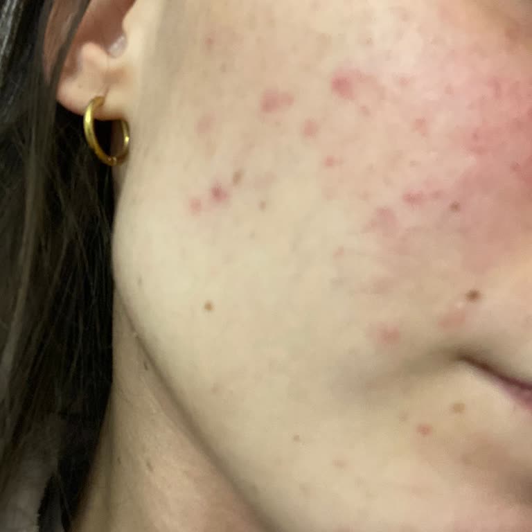 Bioderma Sebium Foaming Gel Caused Dryness, Acne, and Allergy