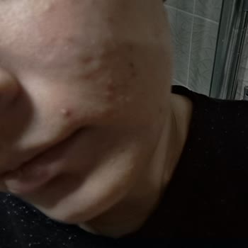 Bioderma Ürünleri Cildimde Yanma Hissi Yarattı