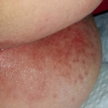 Molfix Bebek Bezi Cilt Sorunlarına Yol Açtı