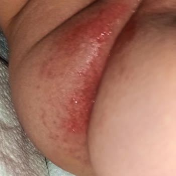 Molfix Bebek Bezi Cilt Sorunlarına Yol Açtı