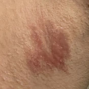 Alerji Ve Leke Sorunu Yaşatan Roll-On Deneyimi