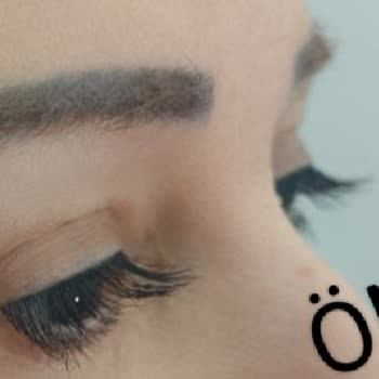 Sym Estetik Klinik Hatası Nedeniyle Kalıcı Kaş Problemi Ve Ekstra Ücret Talebi