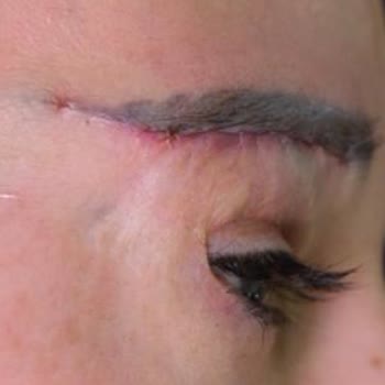 Sym Estetik Klinik Hatası Nedeniyle Kalıcı Kaş Problemi Ve Ekstra Ücret Talebi