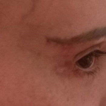 Sym Estetik Klinik Hatası Nedeniyle Kalıcı Kaş Problemi Ve Ekstra Ücret Talebi