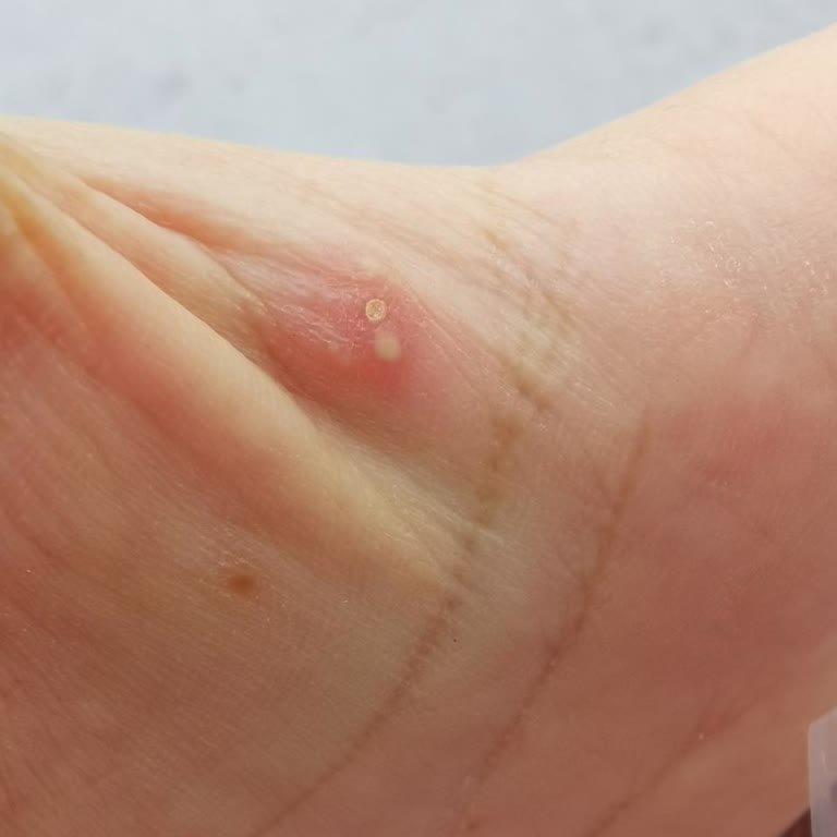 Tehlikeli Yan Etkiler: Klamoks Antibiyotiği