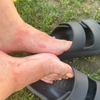 Ecco Sandals Caused Severe Blisters – Requesting Immediate Refund