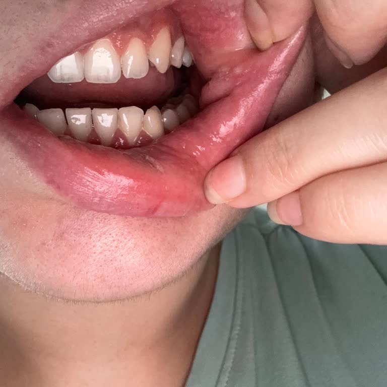 Diş Macunu Kullanımı Sonrası Yaşanan Sağlık Sorunları