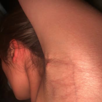 Severe Pain and Cysts from Rexona 72-Hour Roll-On