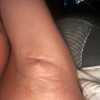 Severe Pain and Cysts from Rexona 72-Hour Roll-On