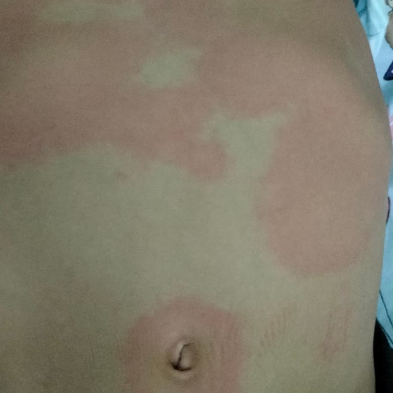 Alerjik Reaksiyon Yapan Bisküvi