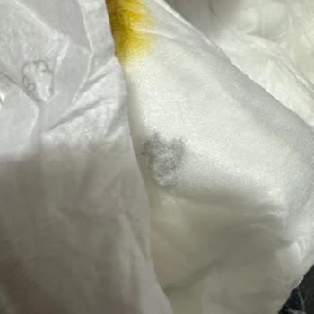 Bebek Bezinde Taş Parçası Şoku!