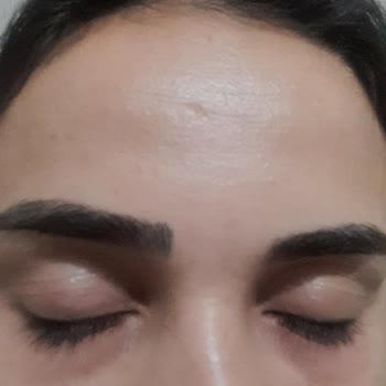 Göz Altı Kremi Kullanımı Sonrası Cilt Reaksiyonu