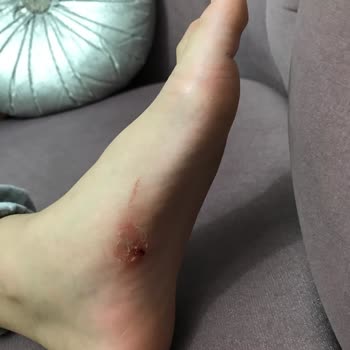 Kinetix Ayakkabı İle Sürekli Ayak Yaralanması