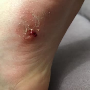 Kinetix Ayakkabı İle Sürekli Ayak Yaralanması