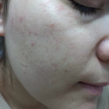 Koreaco Serum Kullanımı Sonrası Cilt Sorunları