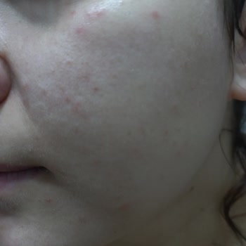 Koreaco Serum Kullanımı Sonrası Cilt Sorunları