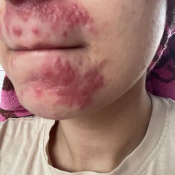 Bezmiâlem Hastanesi Yanlış Teşhis Ve Etkisiz Tedavi Mağduriyeti