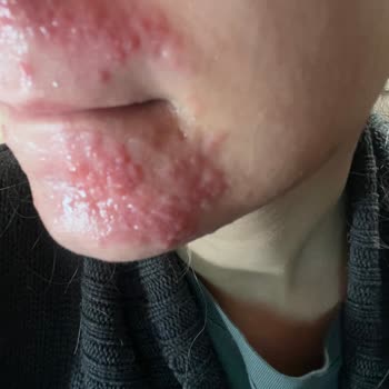 Bezmiâlem Hastanesi Yanlış Teşhis Ve Etkisiz Tedavi Mağduriyeti