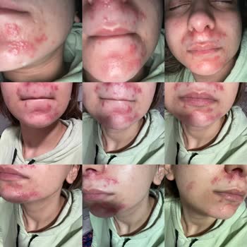 Bezmiâlem Hastanesi Yanlış Teşhis Ve Etkisiz Tedavi Mağduriyeti