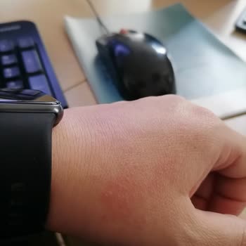 Sephora El Maskesi Alerjik Reaksiyon Yarattı