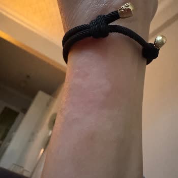 Alerji Yapan Bileklik Sorunu