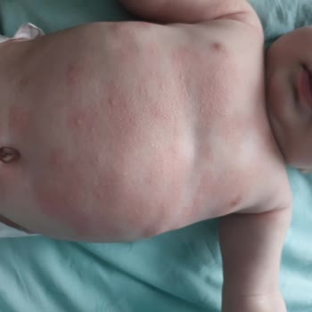 Mustela Ürününde Beklenmedik Alerjik Reaksiyon