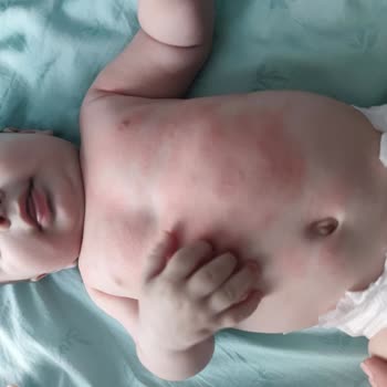 Mustela Ürününde Beklenmedik Alerjik Reaksiyon