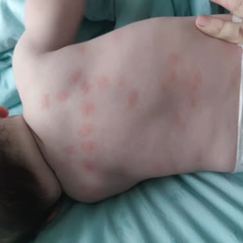 Mustela Ürününde Beklenmedik Alerjik Reaksiyon