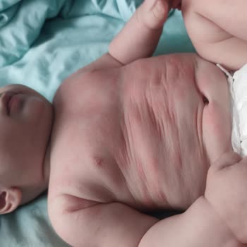 Mustela Ürününde Beklenmedik Alerjik Reaksiyon