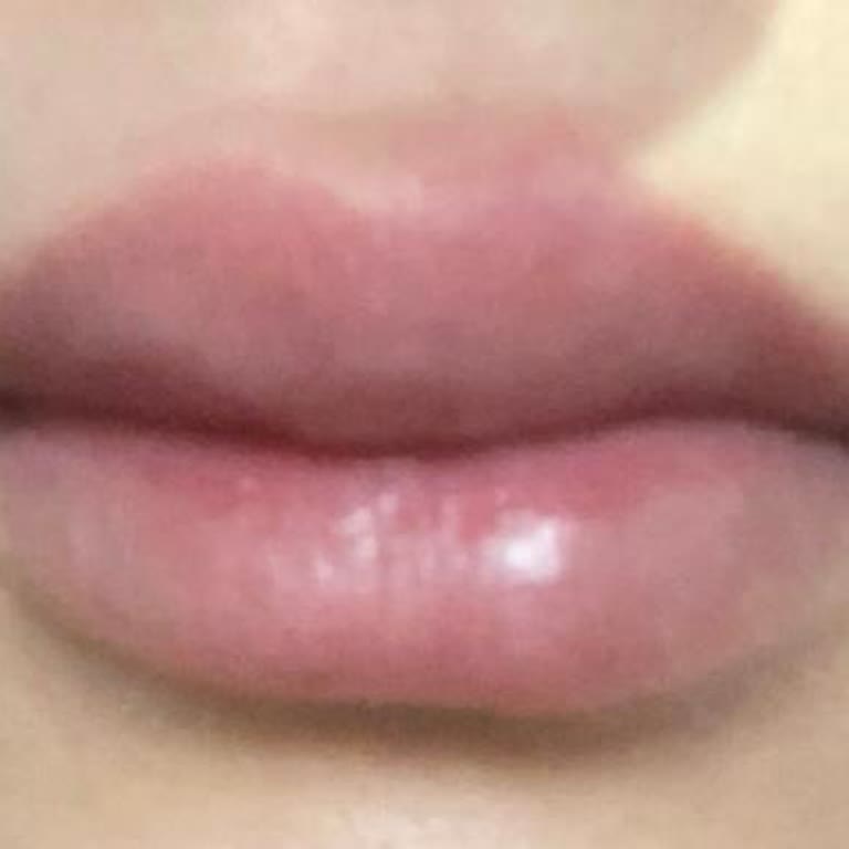 Dudak Dolgusu Deneyiminde Beklenmedik Sorunlar