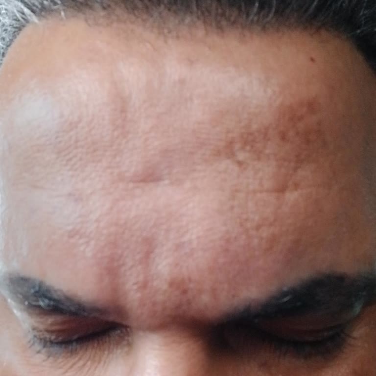 Nihan Ünsal Güzellik & Estetik Dermapen Sonrası Lekelenme Ve İletişim Sorunları