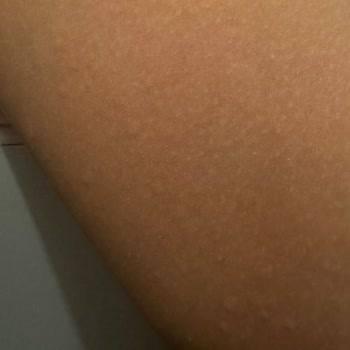 Nesquik Alerjisi: Acil Durum Ve Dava Süreci