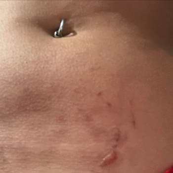 Isı Bandı Yanığı: Şok Edici Deneyim