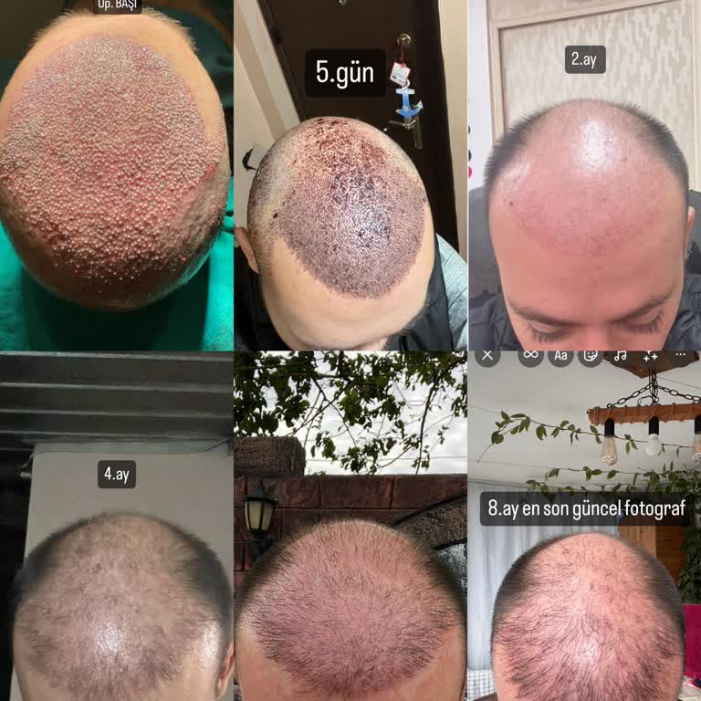 Yüksek Ücretli Saç Ekimi Sonrası İlgisizlik Ve Yetersiz Sonuç