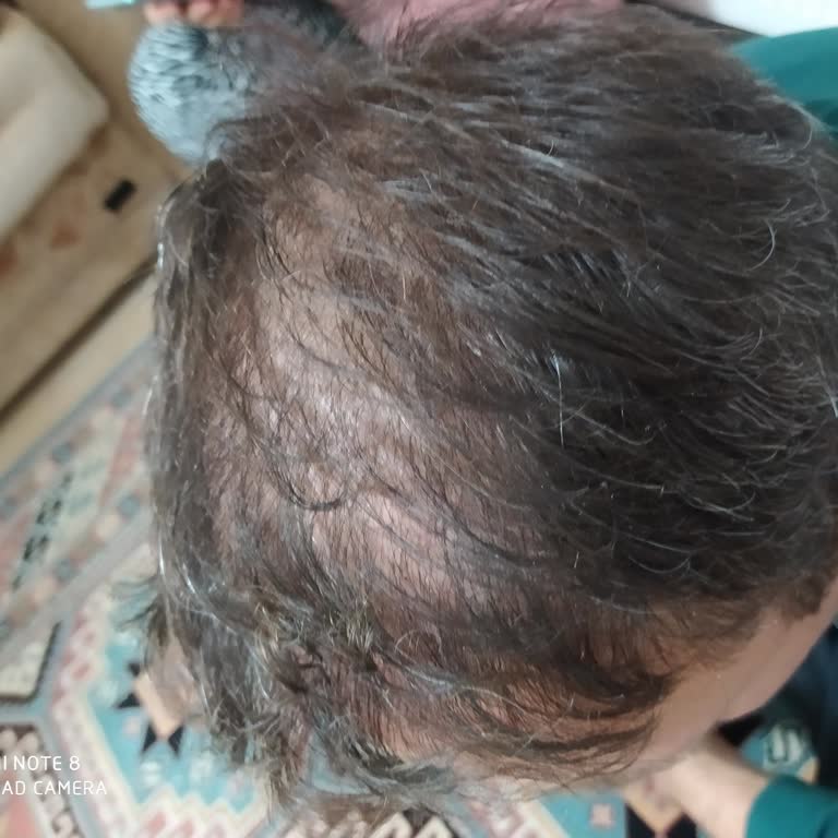 Başarısız Saç Ekimi Ve İlgisiz Hizmet