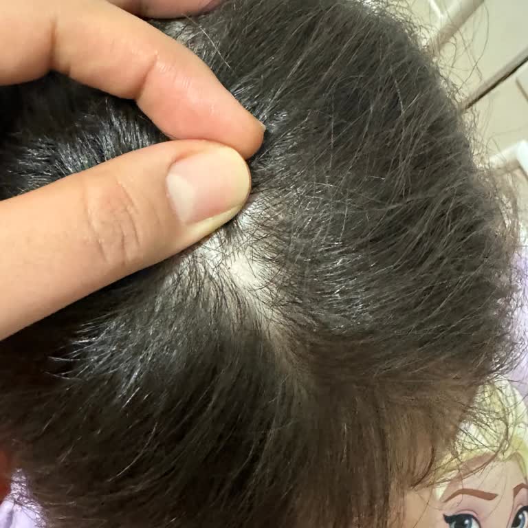 Bebek Şampuanı Kullanımı Sonrası Saç Derisinde Sağlık Sorunları