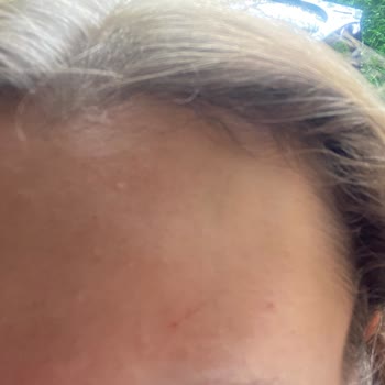 Botoks Sonrası Kaş Orantısızlığı Ve Agresif Tavırlar