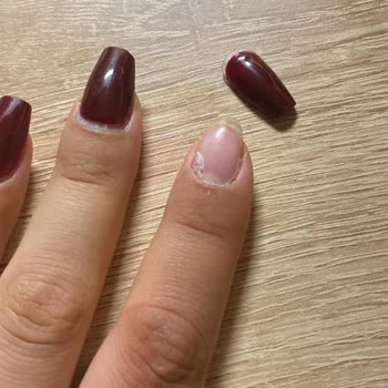 Sürekli Düşen Tırnaklar Ve Yetersiz Telafi Süresi