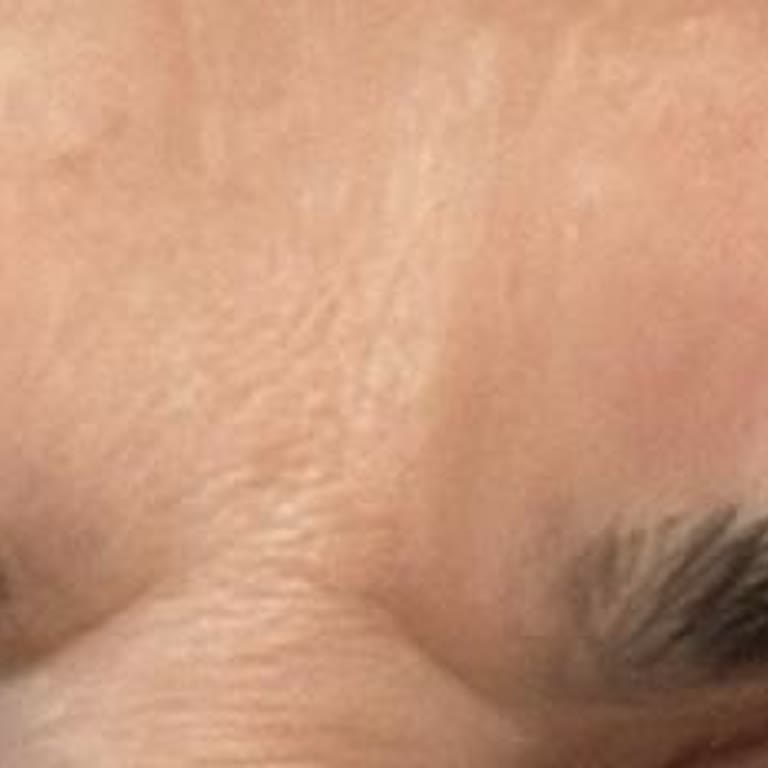 Uzm. Dr. Selim Komar Botoks Yaptı Tutmadı