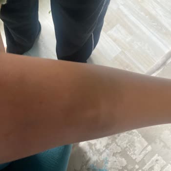 Doğumdan Sonra Geçmeyen Kol Morluğu Ve Ağrı