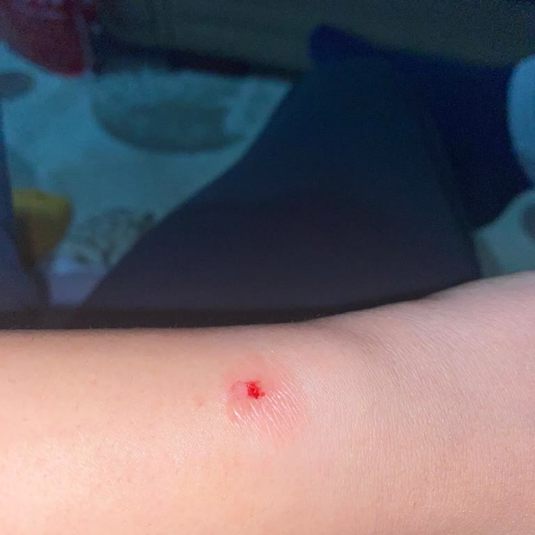 Akıllı Bileklik Yanık Sorunu