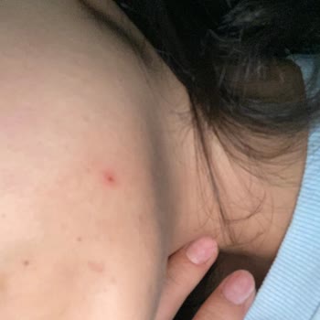 Yves Rocher Gesichtswaschgel ruiniert meine Haut mit schmerzhaften Pickeln