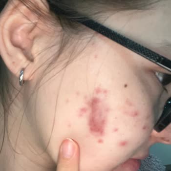 Bioderma Sebium Yüz Yıkama Jeli Cilt Sorunları Yarattı