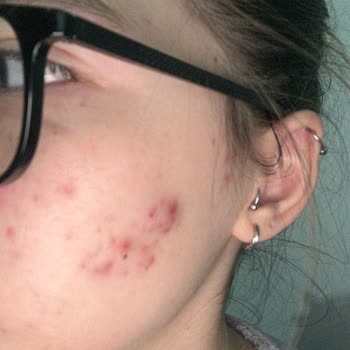 Bioderma Sebium Yüz Yıkama Jeli Cilt Sorunları Yarattı