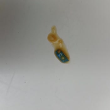 Trabzon Tarım Fıstık Ezmesinin İçinden Yabancı Cisim Çıktı