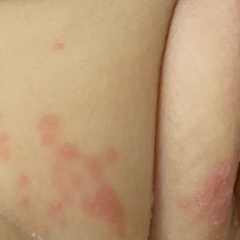 Bebek Bezi Sorunu: Yara Ve Sızıntı Problemleri