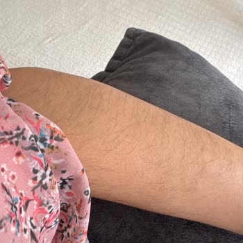 Epilasyon Sonrası Beklenmedik Kıl Artışı