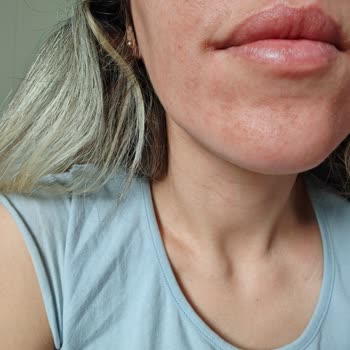 Ciltte Alerji Yapan Krem Hayal Kırıklığı