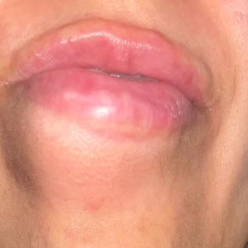 Dr. Ibragimova Lulduz Yanıltıcı Dolgu Deneyimi: Sağlığımız Tehlikede!