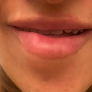 Dr. Ibragimova Lulduz Yanıltıcı Dolgu Deneyimi: Sağlığımız Tehlikede!